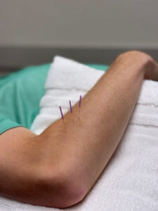 Dry Needling